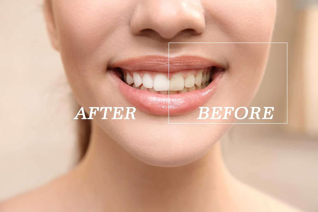 What Are the Most Effective Natural Teeth Whitening Methods You Can Try Worthing?