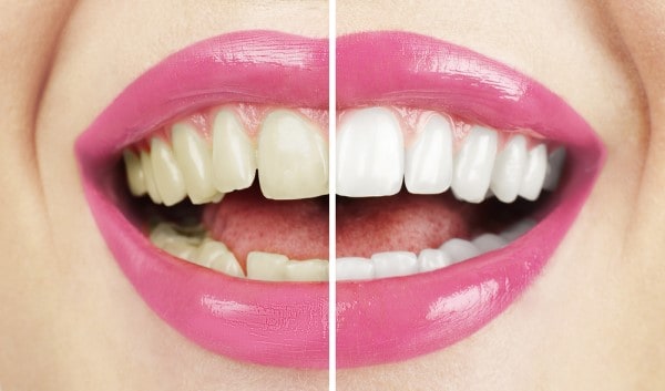 What Makes Ultima White Teeth Whitening Different Worthing