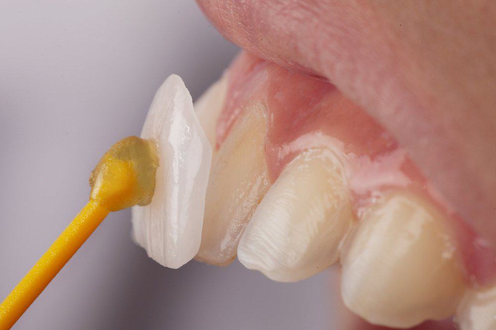 Dental Veneers: Achieving a Flawless Look Worthing