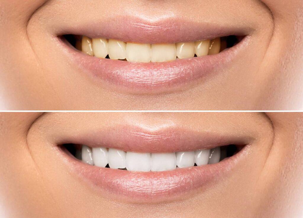 How Does Gum Disease Progress if Left Untreated Worthing?