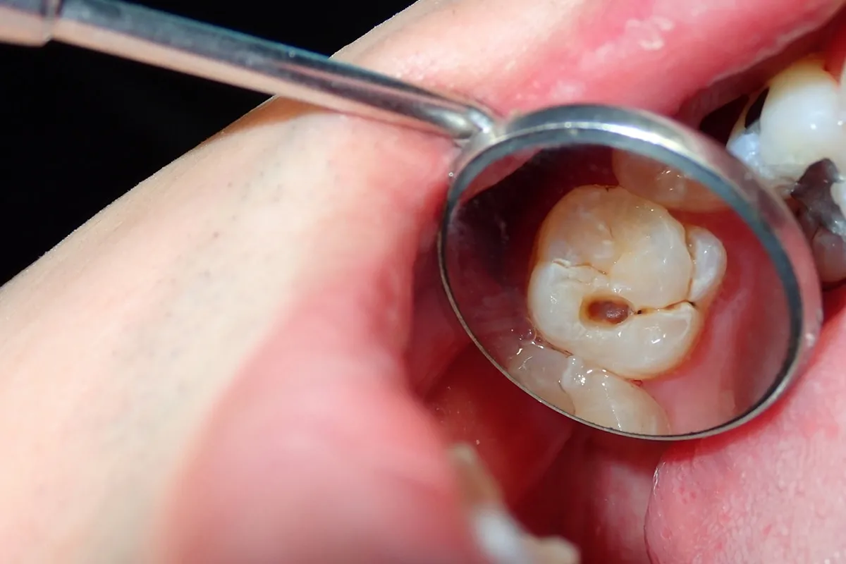 Why Do Teeth Crack? Common Causes to Know Worthing