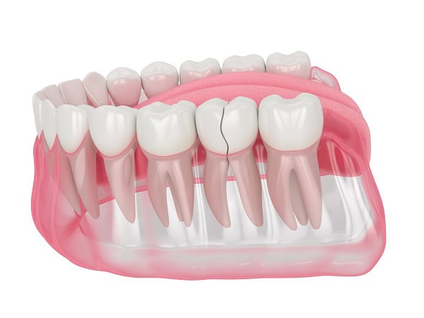 How Can You Manage Pain and Discomfort After a Root Canal Worthing?