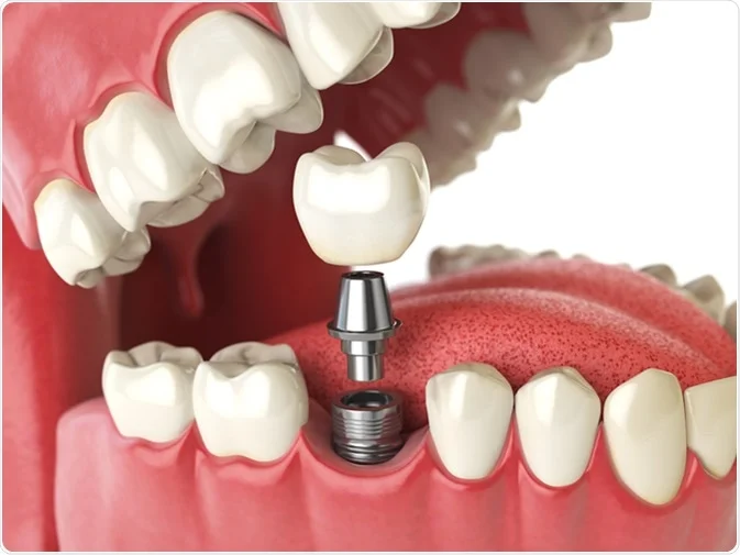 How Do I Decide Which Tooth Replacement Is Right for Me Worthing?
