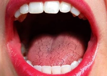 Common Causes of Dry Mouth (Xerostomia) Worthing
