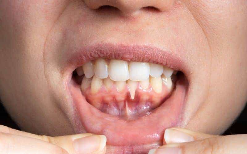 How Can Gum Disease Be Prevented Worthing?