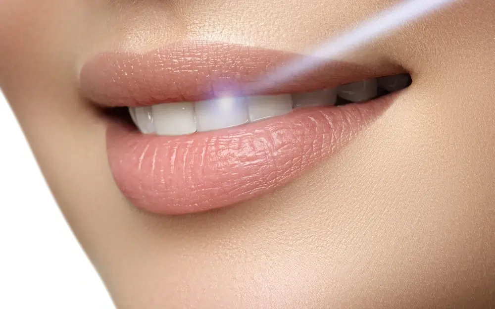 How Long Does Laser Teeth Whitening Last on Your Teeth Worthing?