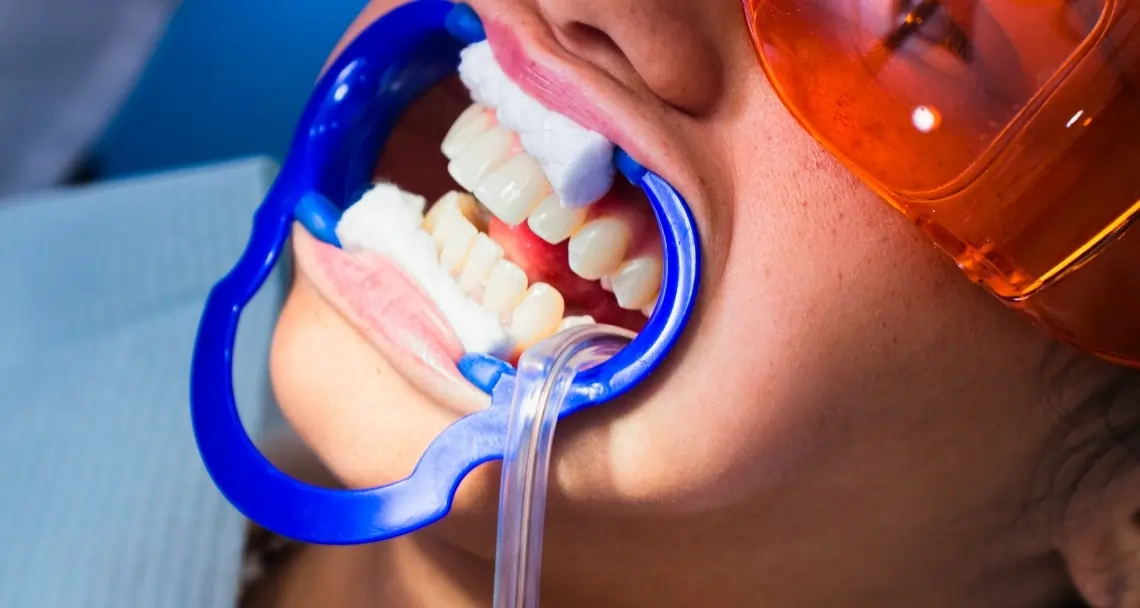 FAQs: Laser Teeth Whitening vs. At-Home Kits Worthing