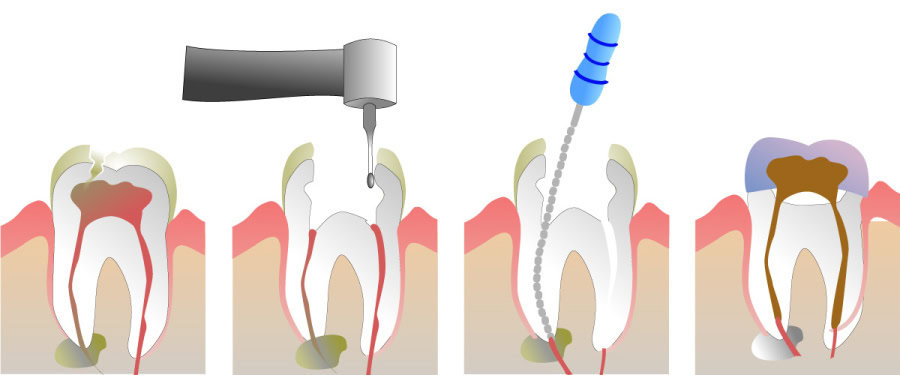 How Do You Properly Care for Your Teeth After a Root Canal Worthing