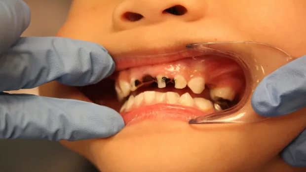 Tips for Keeping Your Child’s Baby Teeth Healthy and Strong Worthing