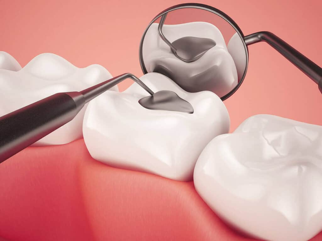 How Can You Prevent Tooth Decay Effectively Worthing
