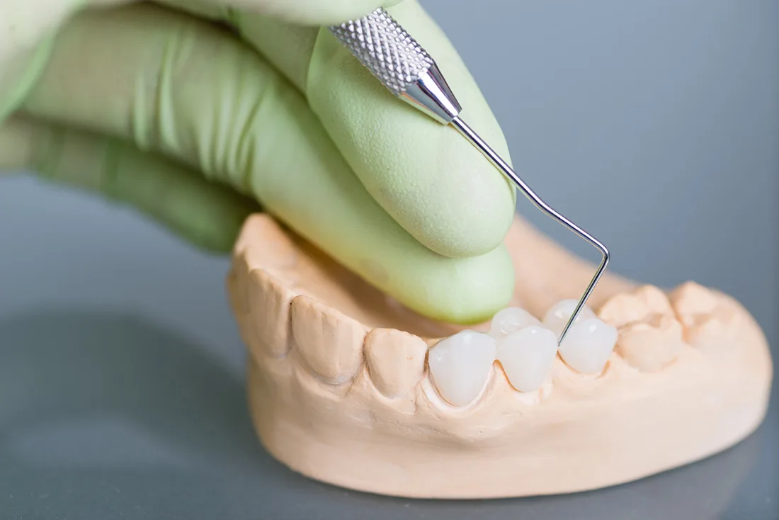 What Are the Different Types of Dental Crowns Available Worthing?