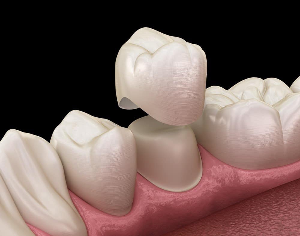 How Can You Prevent Common Dental Crown Problems Worthing?