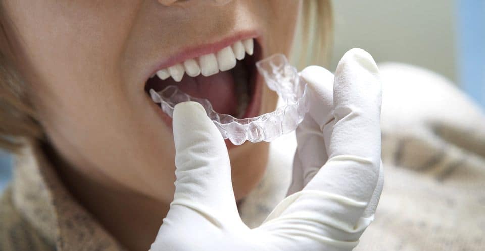 Why Bleaching Trays Require More Time Worthing