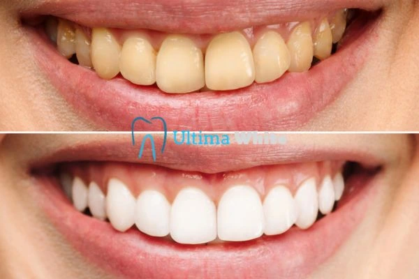 Why Might Multiple Whitening Sessions Be Necessary Worthing?