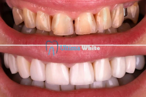 What Makes Instant Teeth Whitening Treatments So Popular Worthing?