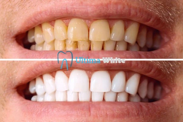 Stained Teeth and Persistent Bad Breath Worthing