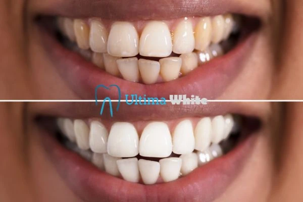 Aftercare Tips to Maintain Your New Smile Worthing